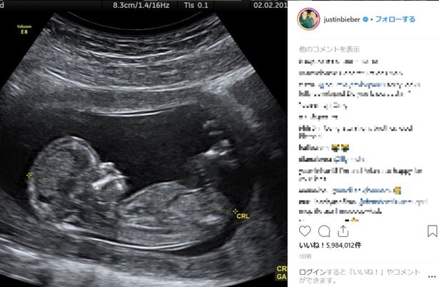 【写真を見る】ジャスティン・ビーバー、はっきり胎児が見えるエコー写真を投稿！ファン騒然の事態に